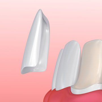 Transform Your Smile with Dental Veneers