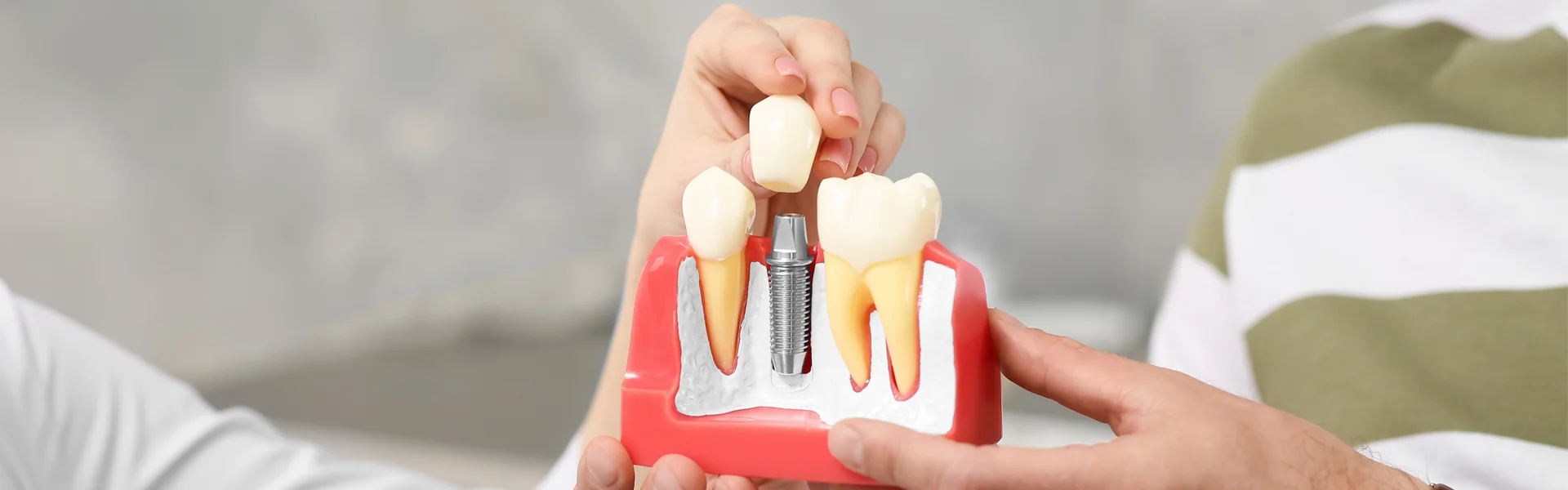 Top 10 Important Facts About Dental Implants